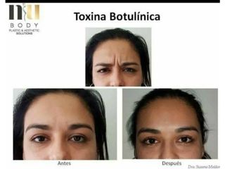 Antes y después de Toxina botulínica