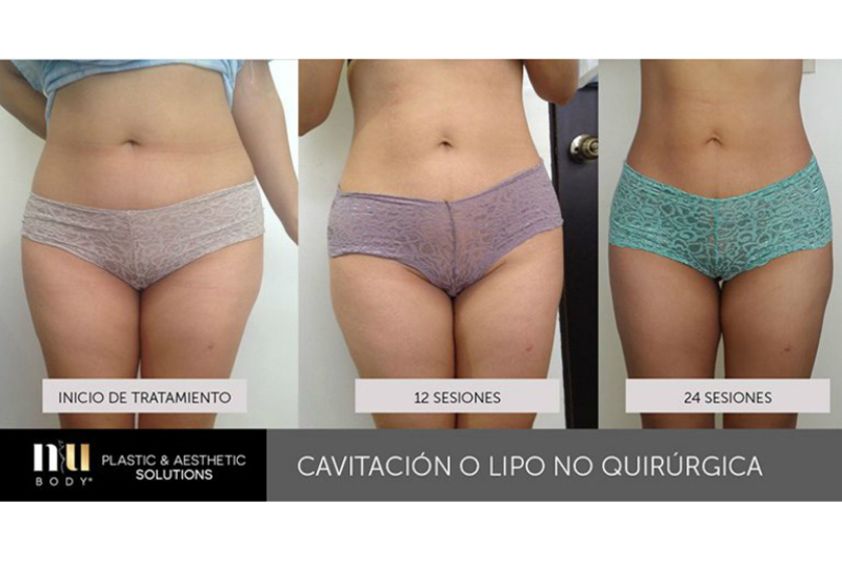 Cavitación antes y después - 630883