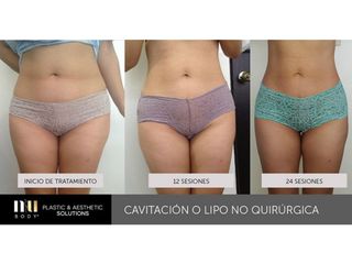 Antes y después de Lipoescultura