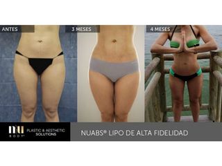 Antes y después de Lipoescultura