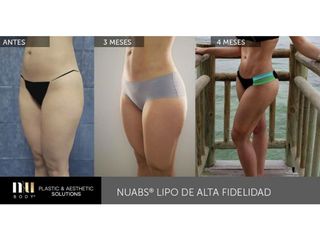 Antes y después de Lipoescultura