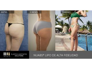 Antes y después de Lipoescultura