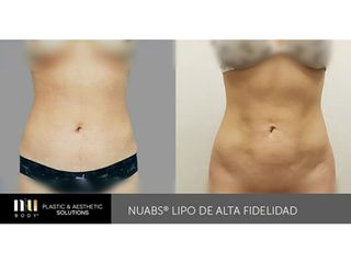 Antes y después de Lipoescultura