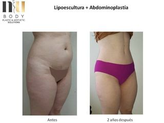 Antes y después de Abdominoplastia