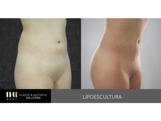 Antes y después de Lipoescultura