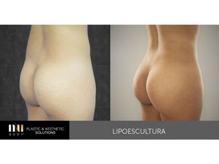 Antes y después de Lipoescultura