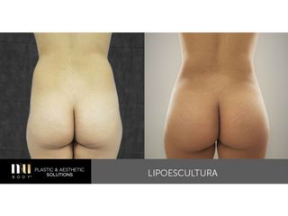 Antes y después de Lipoescultura