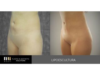 Antes y después de Lipoescultura