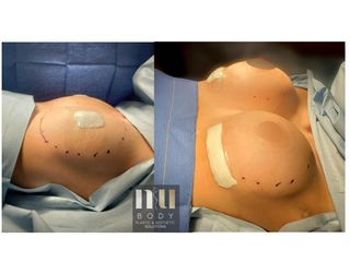 Antes y después deAumento de busto subpectoral