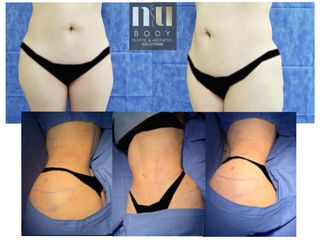 Antes y después de Lipo con lipoinyección a cadera