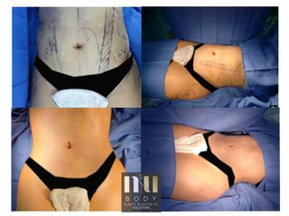 Antes y después de Lipo con vaser y lipoinyección a cadera