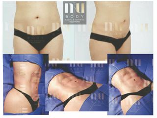 Antes y después de Lipo hd con vaser