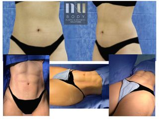 Antes y después de Lipo hd con vaser 