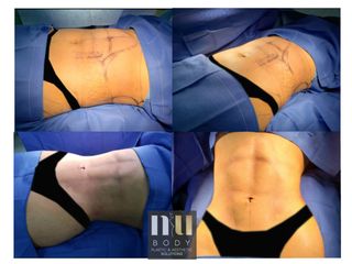 Antes y después de Lipo hd con vaser