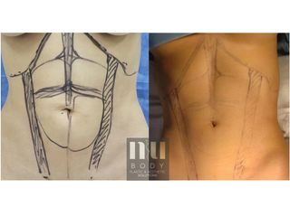 Antes y después de Lipo secundaria con vaser