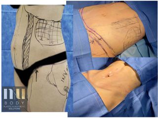 Antes y después de Lipoescultura con vaser + miniabdominoplastia
