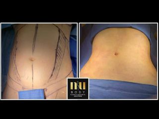 Antes y después de Lipoescultura con vaser