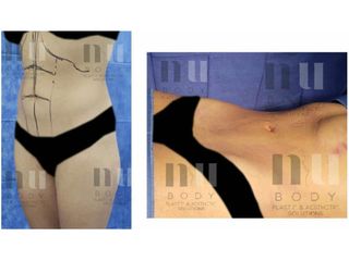 Antes y después de Lipoescultura