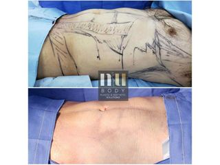 Antes y después de Liposucción con vaser (hombre) 