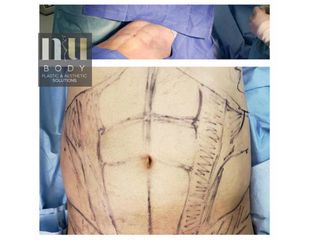 Antes y después de Liposucción con vaser (hombre)