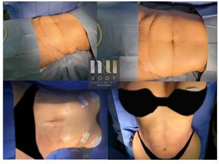 Mommy makeover (lipoescultura, lipectomía y levantamiento de busto con aumento