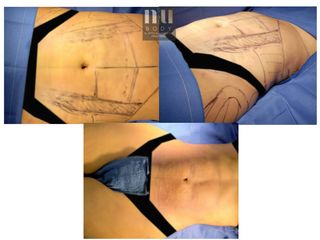 Antes y después de Lipo con vaser y aumento de busto