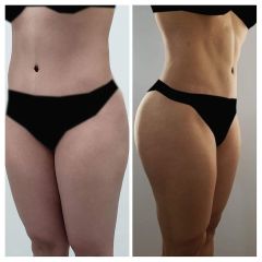  LipoHD de abdomen con lipoinyección glútea y VASER