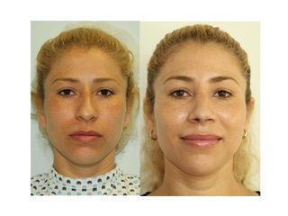 Antes y después de Rinoplastia a 1 año de operada