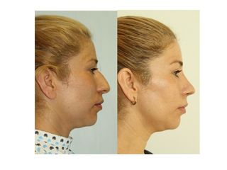 Antes y después de Rinoplastia