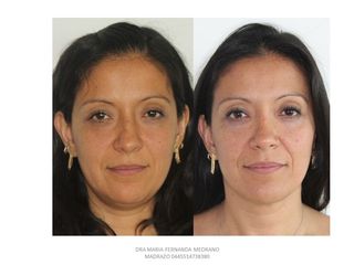 Antes y después de Rinoplastia secundaria