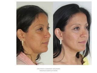 Antes y después de Rinoplastia secundaria