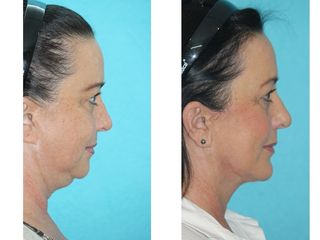 Antes y después de Rejuvenecimiento de Cuello