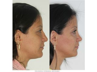 Antes y después de Rinoplastia