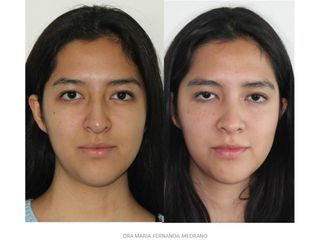 Antes y después de Rinoplastia