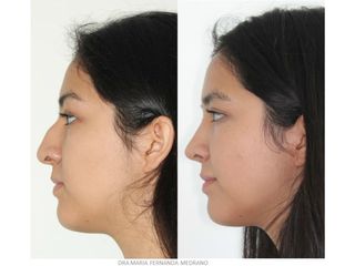 Antes y después de Rinoplastia