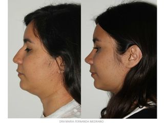 Antes y después de Rinoplastia