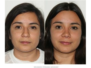 Antes y después de Rinoplastia