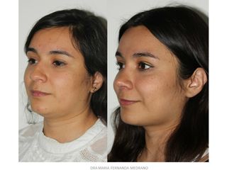 Antes y después de Rinoplastia