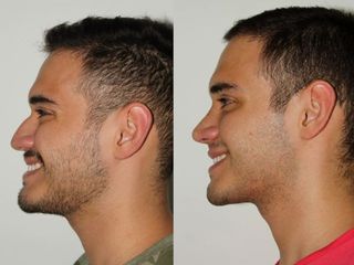 Antes y después de Rinoplastia