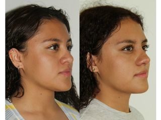 Antes y después de Rinoplastia