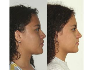 Antes y después de Rinoplastia