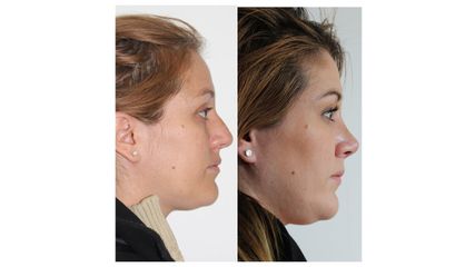 Antes y después de Rinoplastia