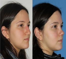 Antes y después de Rinoplastia