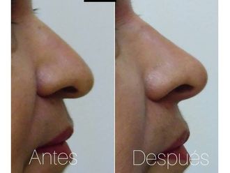 Rinoplastia - 632939