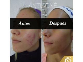 Antes y después de Tratamiento Antiacné