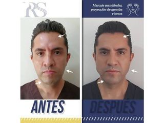 Antes y después de Mentoplastia y toxina botulínica