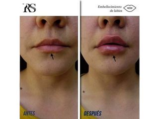 Antes y después de Relleno de Labios