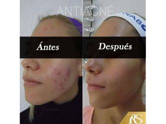 Tratamiento antiacné - 640566