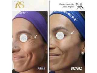 Antes y después de Rejuvenecimiento Facial