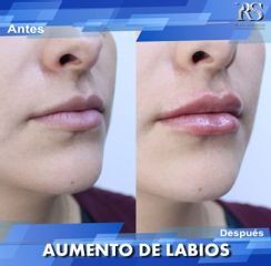 Antes y después de Relleno de labios 